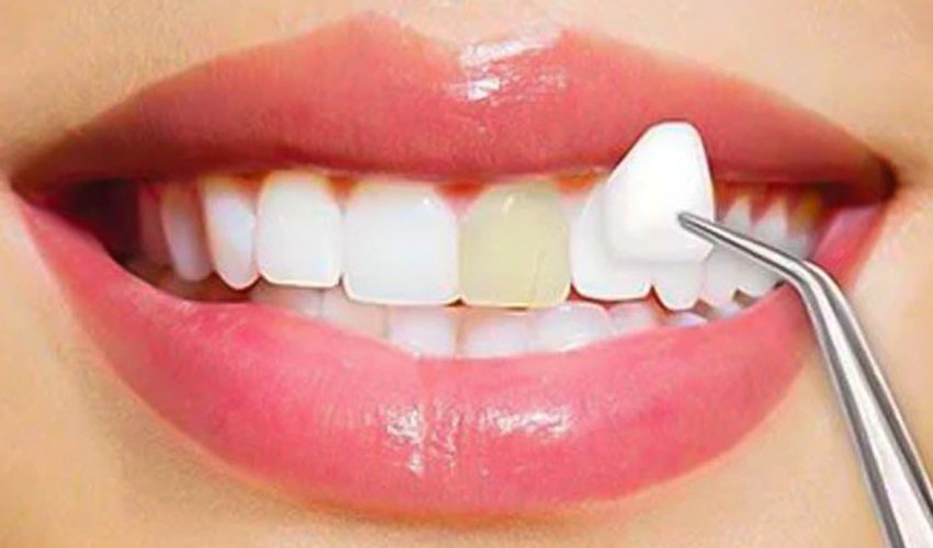 Effective Ways to Take Care of Your Porcelain Veneers – Maintaining health