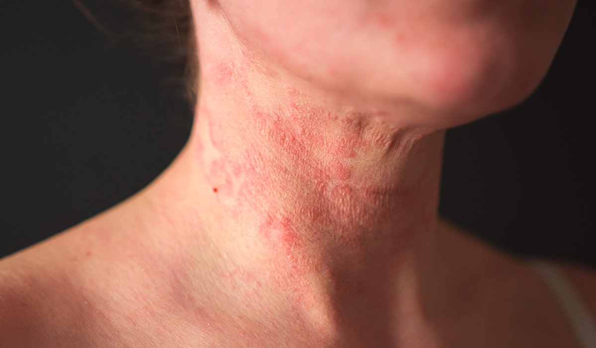 Eczema (Atopic Dermatitis): Causes, Symptoms & Treatment