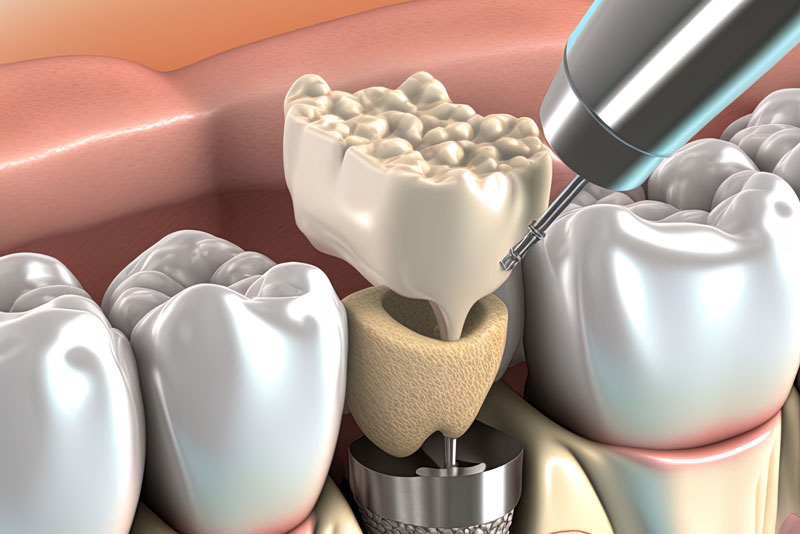 Dental Implant Baton Rouge, LA | Pearl Dental Group