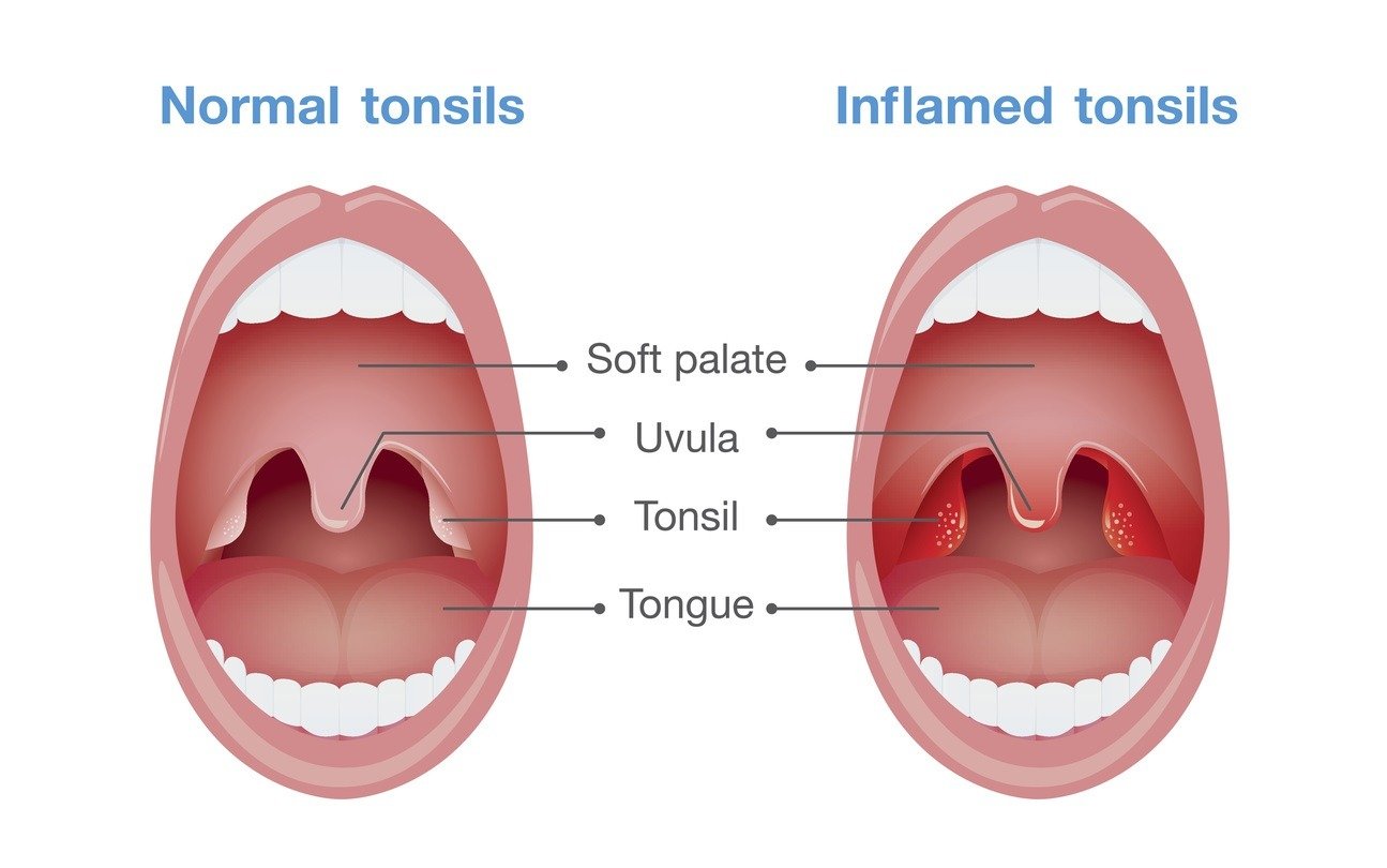 Tonsil Surgery - 247homeopathy