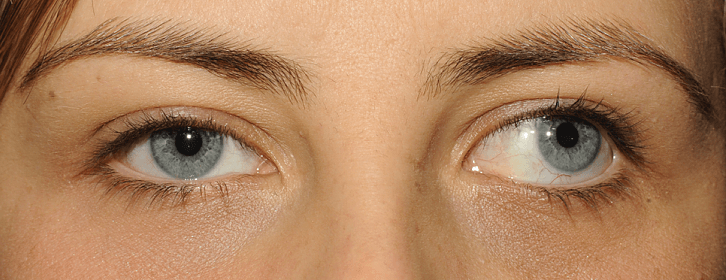 All about Squint, its causes and treatment | Deevine Eye Care