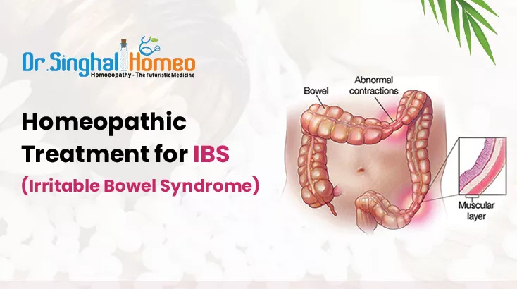 Homeopathy for IBS Treatment - An Effective & safer Alternative - AtoAllinks