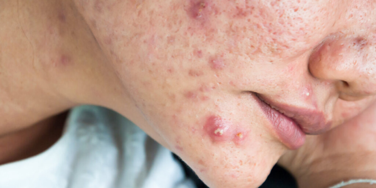 Cystic acne treatment by Apax Medical & Aesthetics Clinic