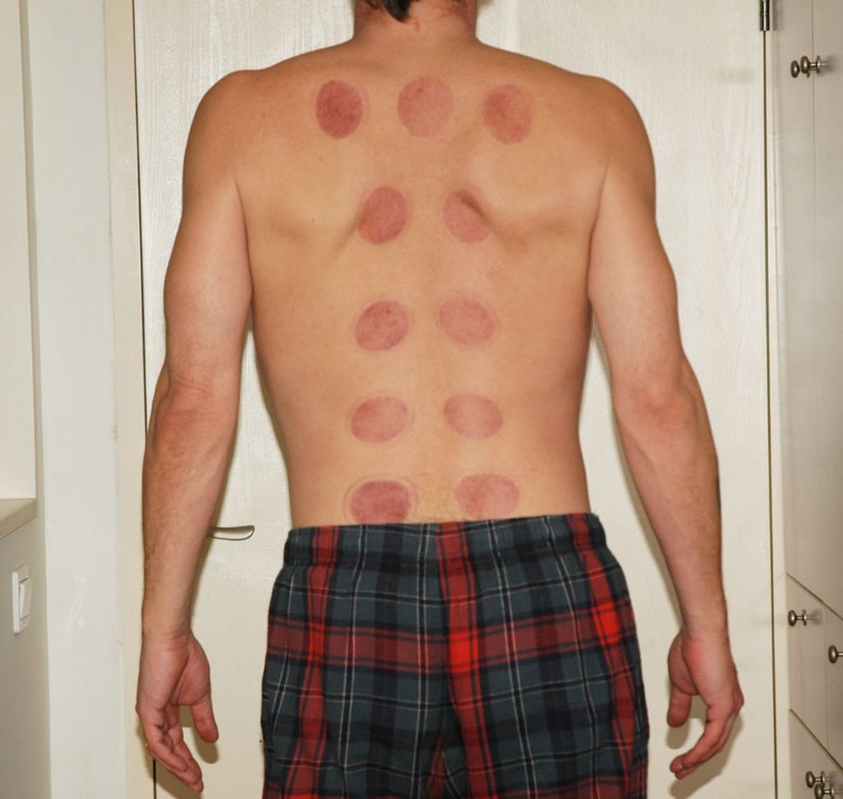 Demystifying Cupping Therapy and its Potential Benefits