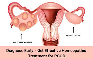 Best Homeopathic Medicine & Treatment for PCOD in India