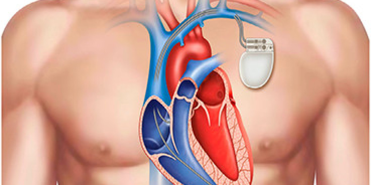 Pioneering Pacemaker Implantation: Advancements in Delhi's Cardiac Care