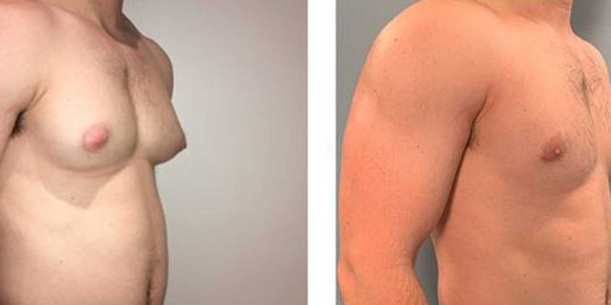 Am I Too Young For Undergoing Gynecomastia Surgery?
