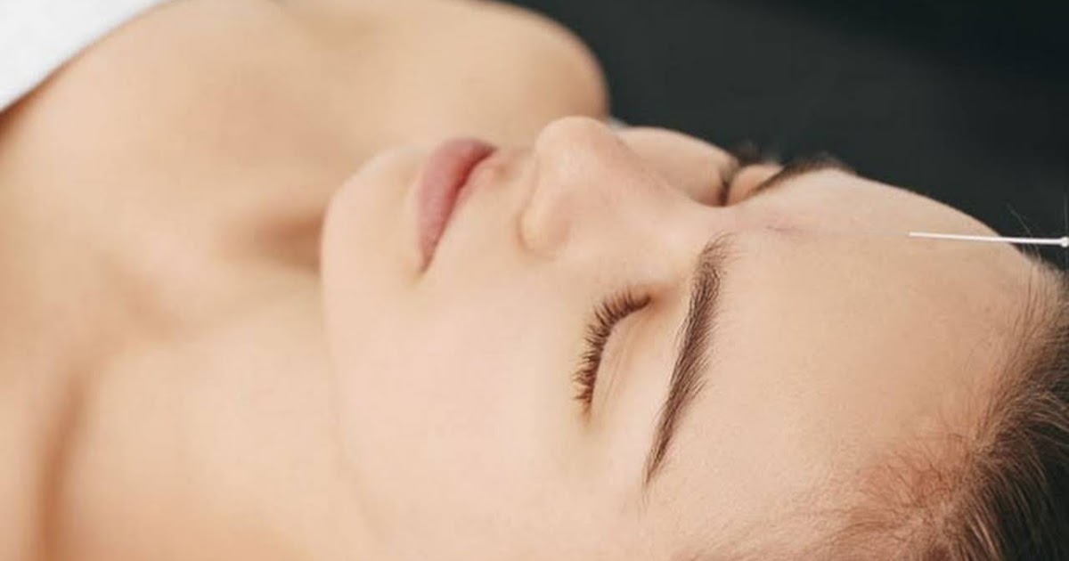 Exploring the Remarkable Benefits of Acupuncture for Headache Relief