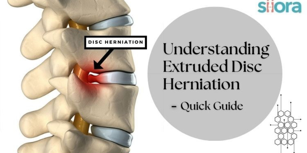 Understanding Extruded Disc Herniation - An Easy Guide