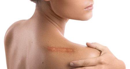 Keloid Solutions in Texas | Expert Scar Treatment From Specialists