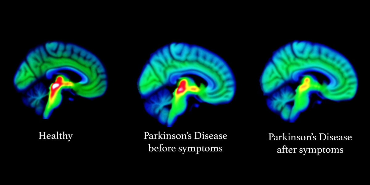 Parkinson’s Disease Therapeutics Market Application and Industry Forecast Report 2033