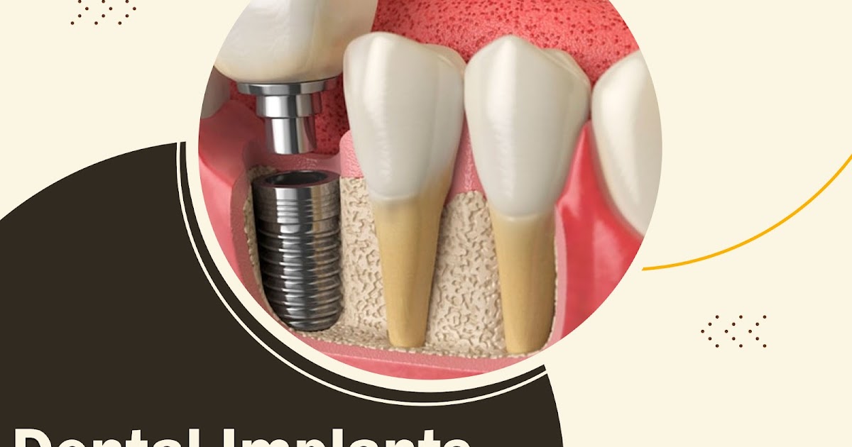 Dental Implants for Seniors. Costs | Benefits