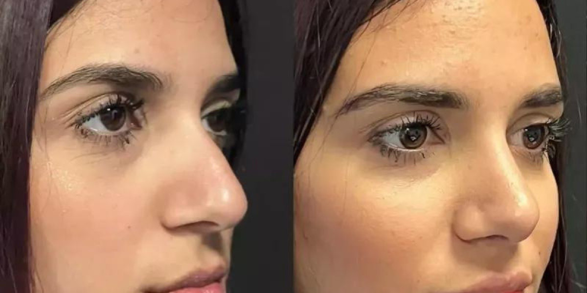 Transforming Lives: Real Stories of Rhinoplasty in Dubai