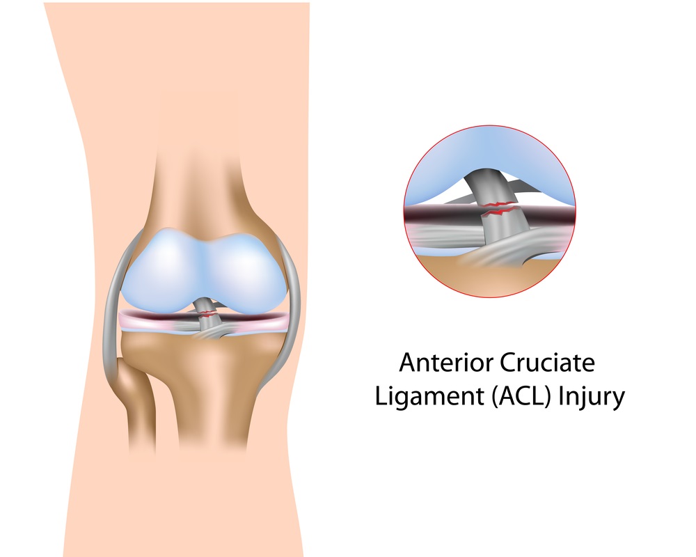 ACL Reconstruction Surgery & Injury Treatment | Lancashire Clinic