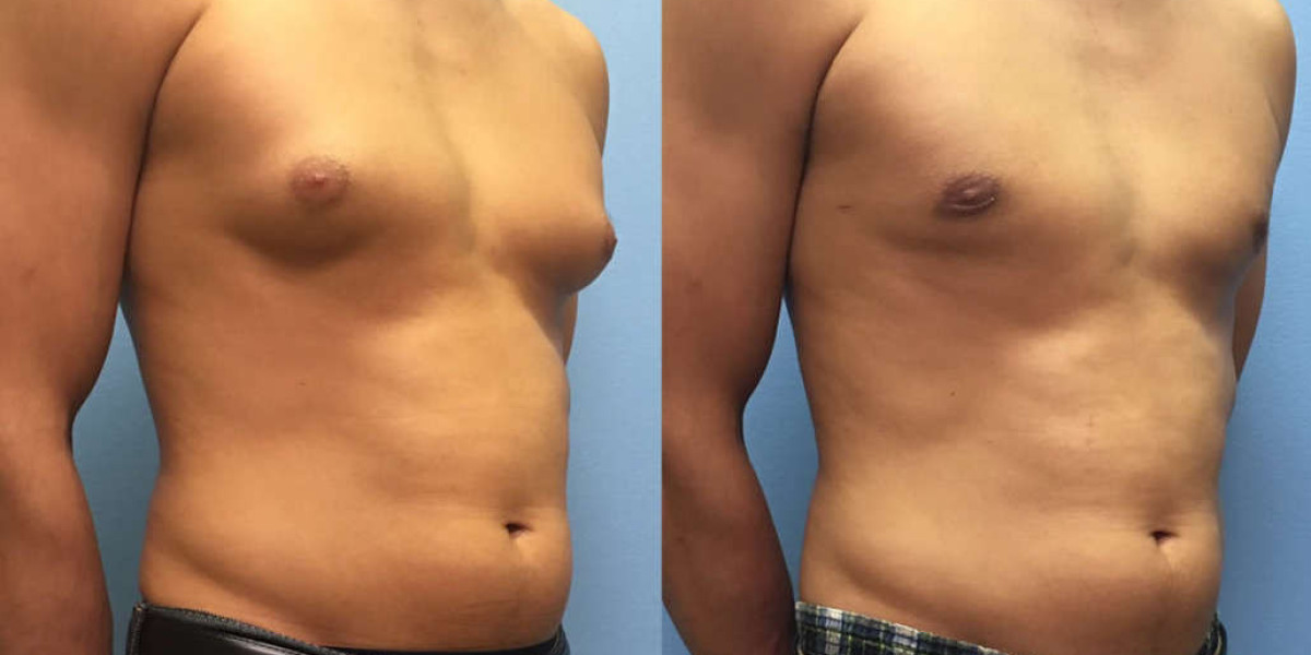 Choosing the Best Gynecomastia Doctors in Pune: A Comprehensive Guide