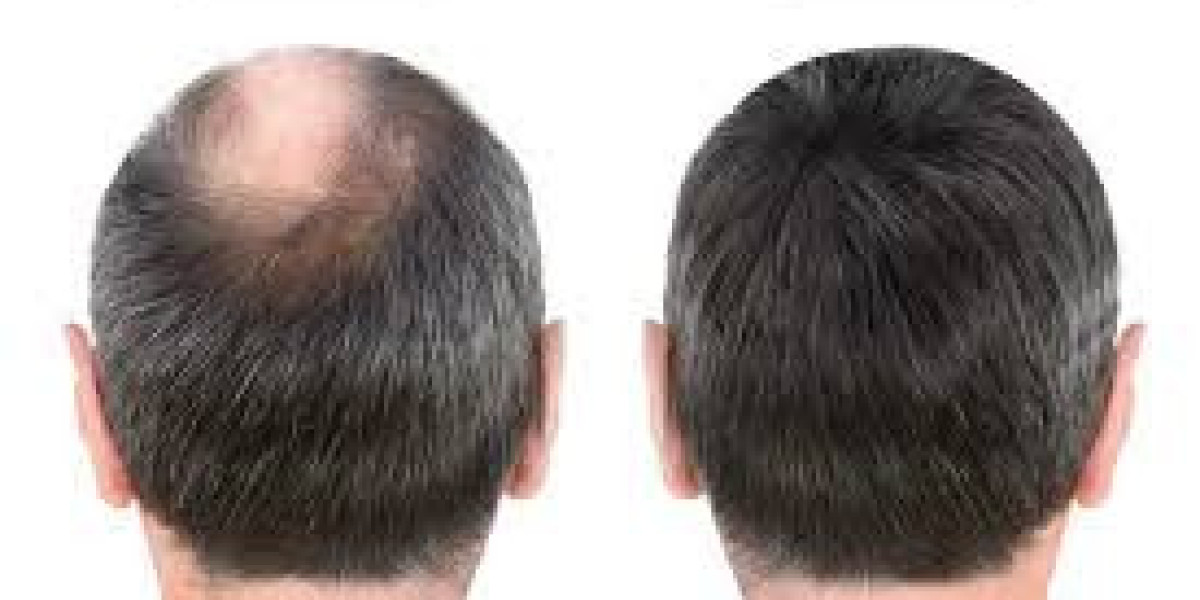 Beyond Balding: Non-Surgical Interventions for Fuller, Healthier Hair