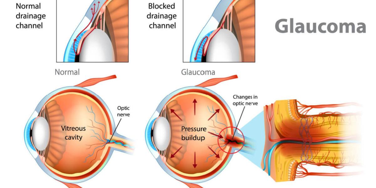 Glaucoma Market Rising in Demands and Growth Insights till Forecast 2024 to 2033