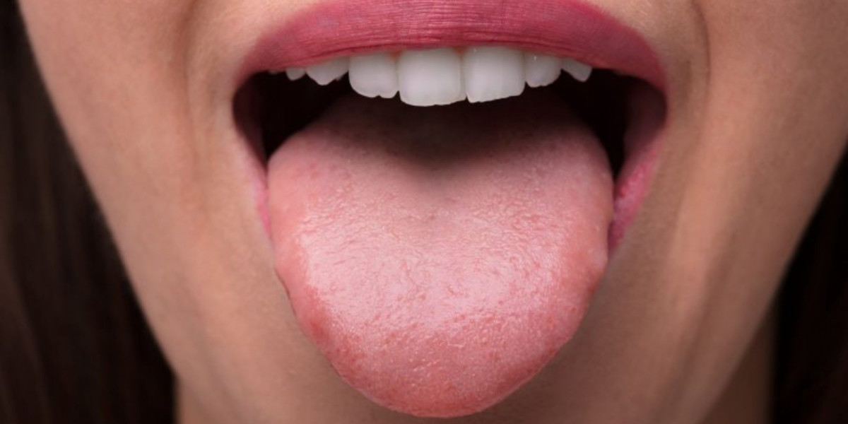 Understand the Symptoms of HPV Bumps on the Tongue