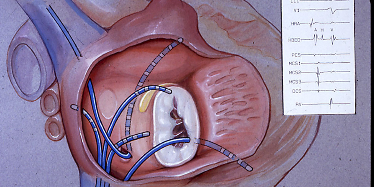 Electrophysiology Devices: Market Growth and Opportunities