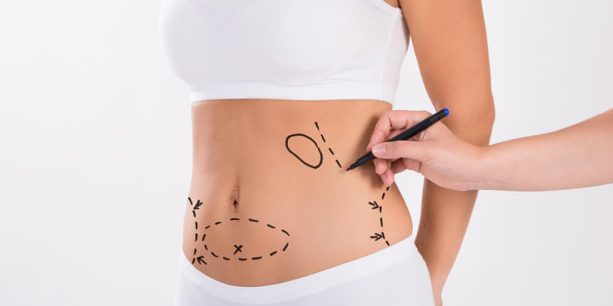 Liposuction Holiday Packages in Dubai