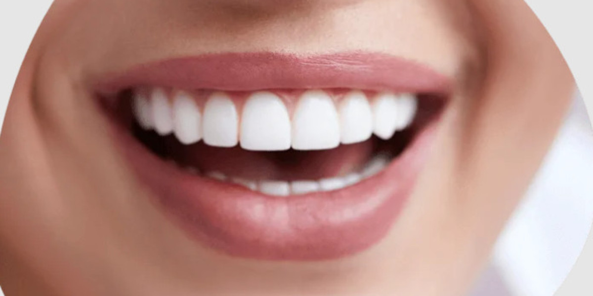 Achieving the Perfect Smile with Guglielmo Smile: A Comprehensive Guide
