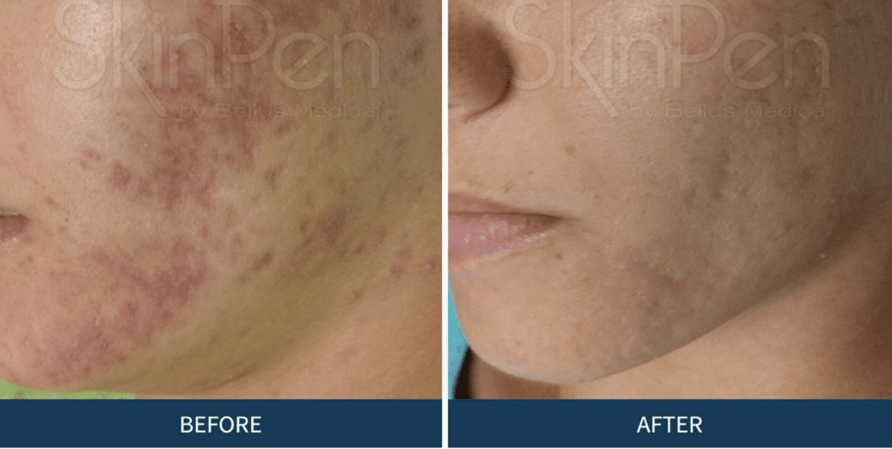 What to Expect from Your First Microneedling Session for Acne Scars