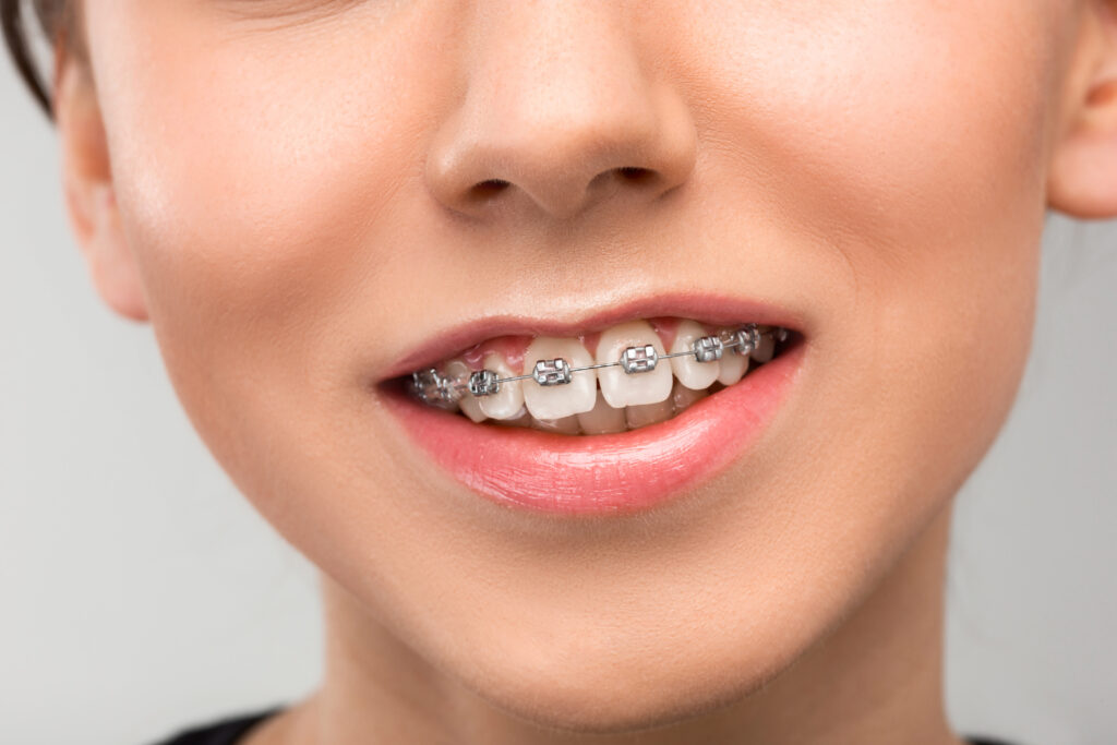 Pediatric Dentistry Insights: Signs Your Child Might Need Braces - Phoenixdentcare