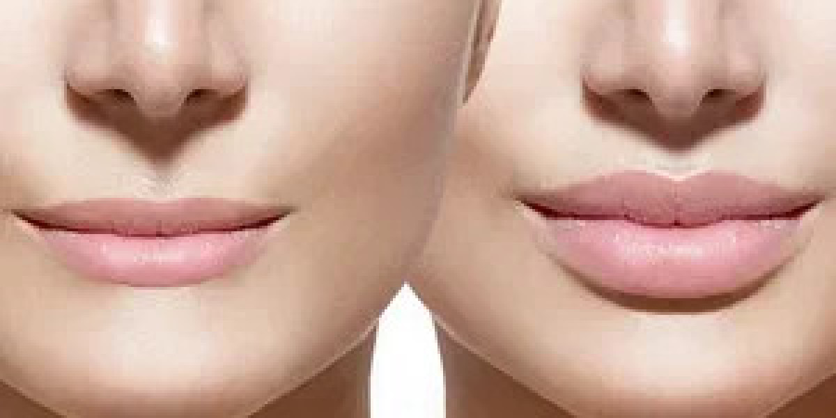 Choosing Between Upper and Lower Lip Reduction in Islamabad