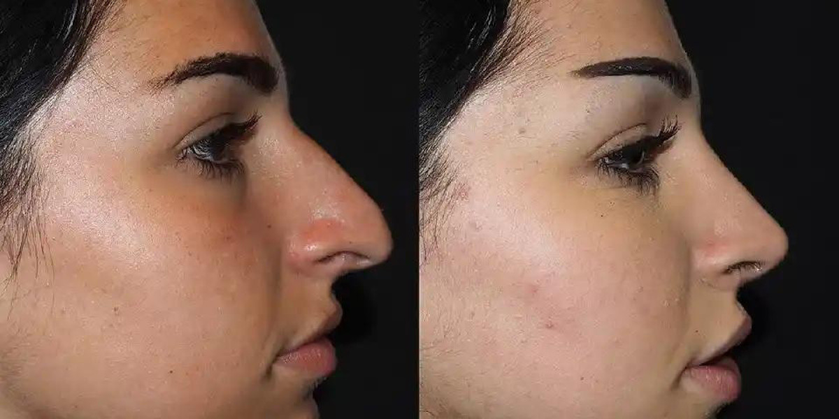 How to Choose the Right Rhinoplasty Surgeon for Your Gender