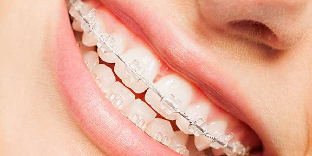 Transform Your Smile: Clear Aligners in Las Vegas