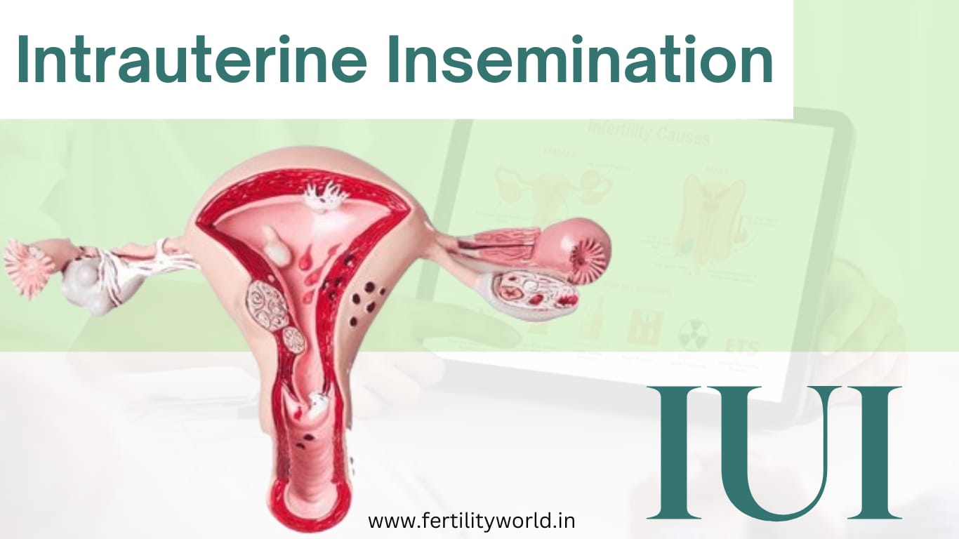 Intrauterine Insemination (IUI) | Fertilityworld