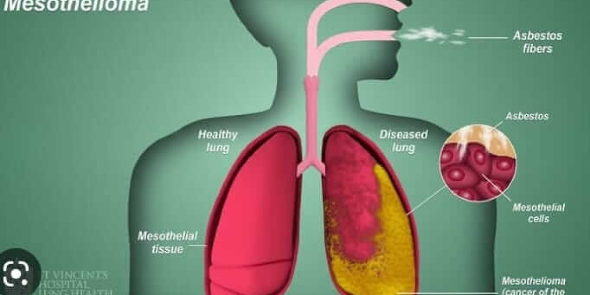 Mesothelioma: Uncovering the Silent Killer Linked to Asbestos Exposure