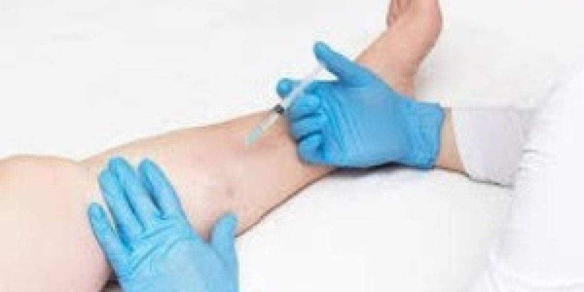 The Latest Non-Invasive Vein Treatments Available in NYC