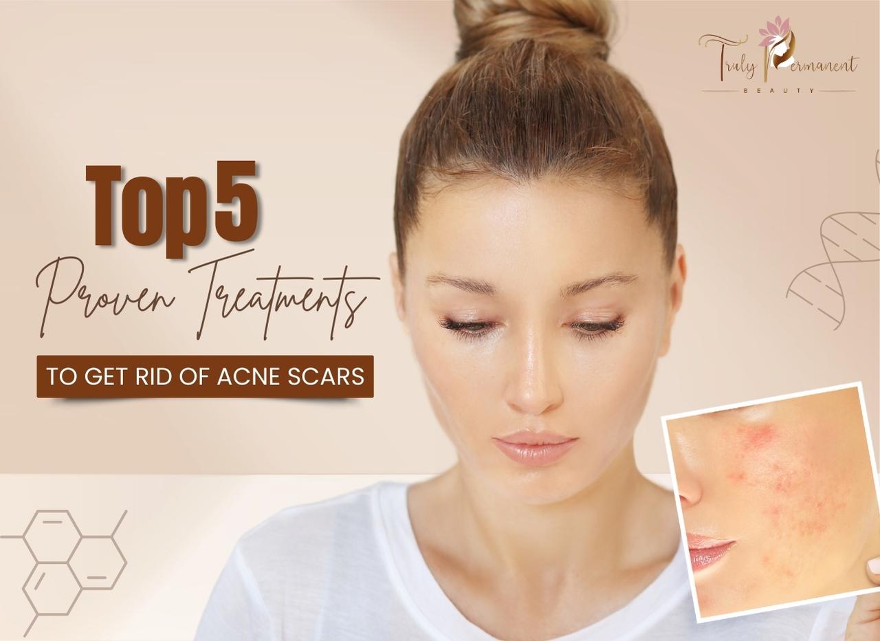 Top 5 Proven Treatments to Get Rid of Acne Scars | Truly Permanent Beauty