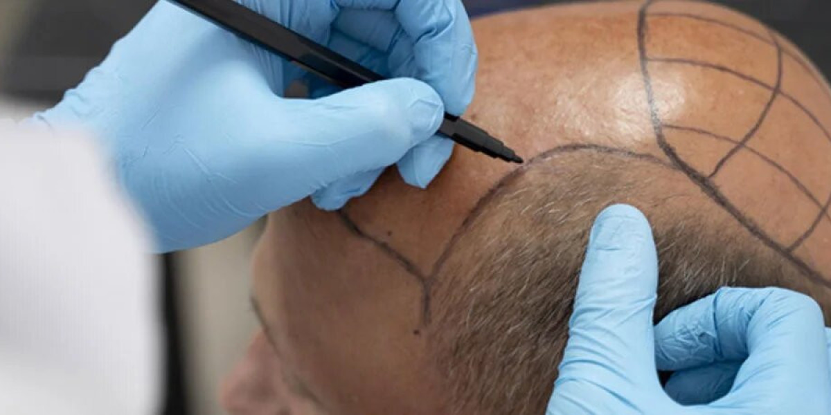 Why is FUE Transplantation An Effective Treatment in Baldness Management?