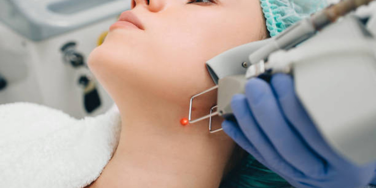 Is Laser Mole Removal Painful?