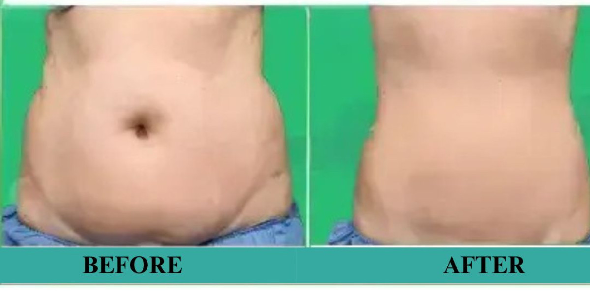 Weight Loss Surgery in Delhi: Achieve Lasting Results