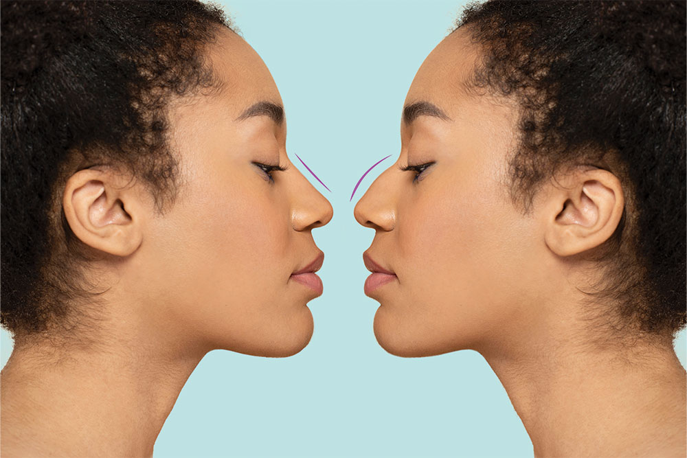 Non-surgical Rhinoplasty - Escape Aesthetics Dunstable