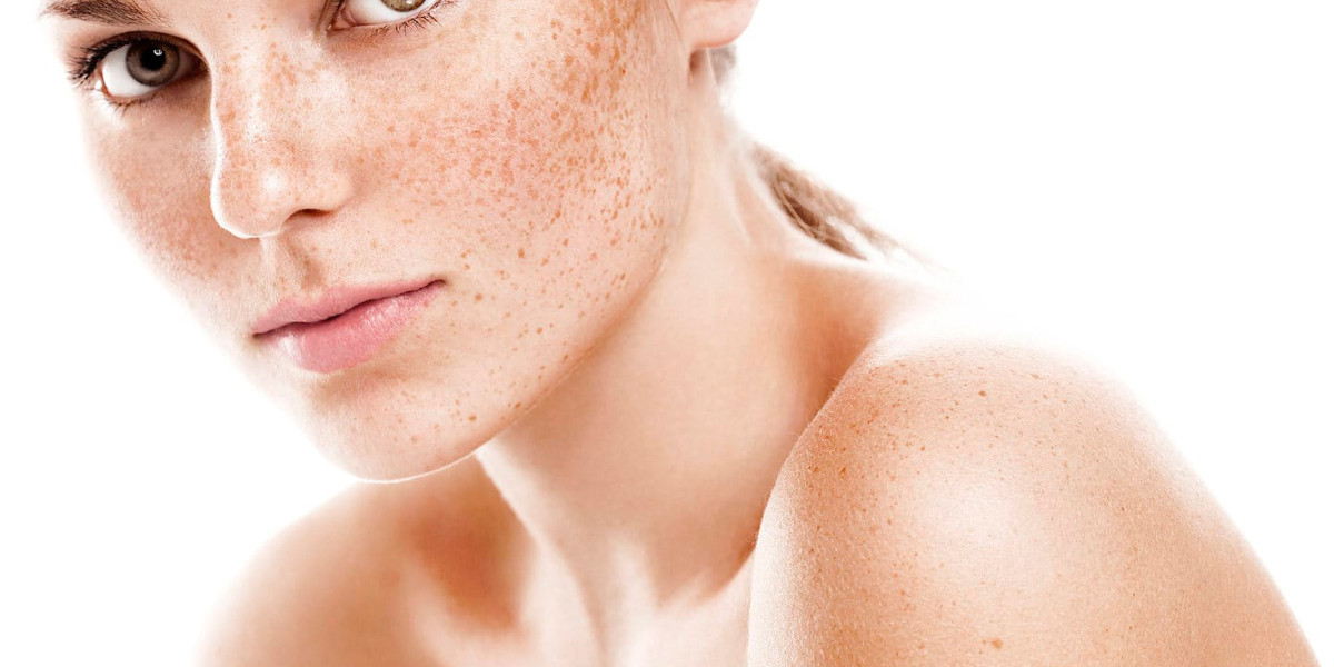 Melasma Treatment in Islamabad: Expert Solutions for Clearer Skin