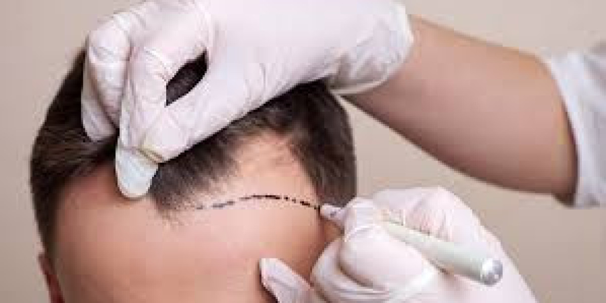 Hair Transplant London: Merging Technology and Artistry for Results You Never Thought Possible"