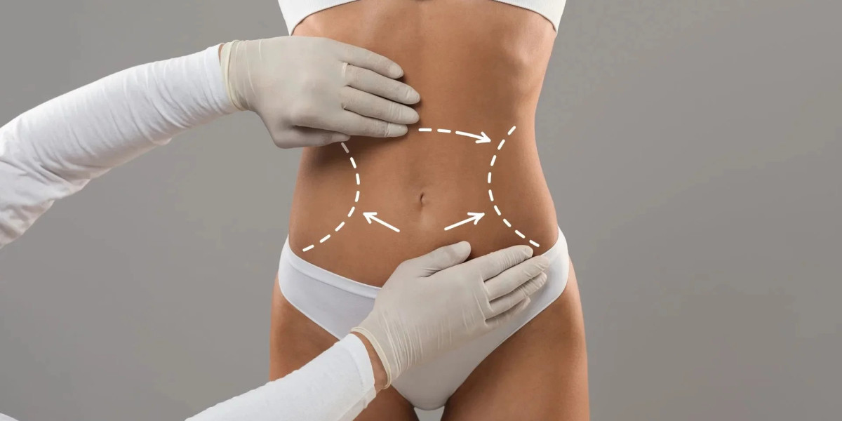 Top 5 Things You Should Know About Liposuction in Islamabad