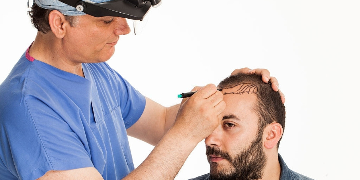 How to Avoid Common Hair Transplant Mistakes