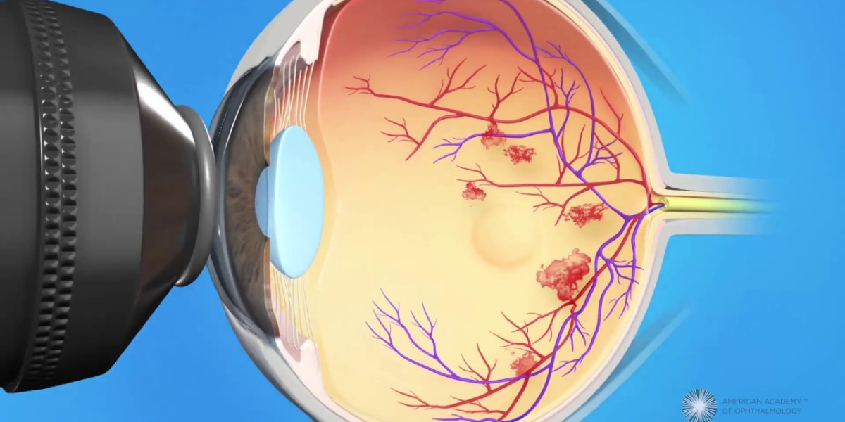 Diabetic Macular Edema Therapy Market is Driven by Rising Incidence of Diabetes