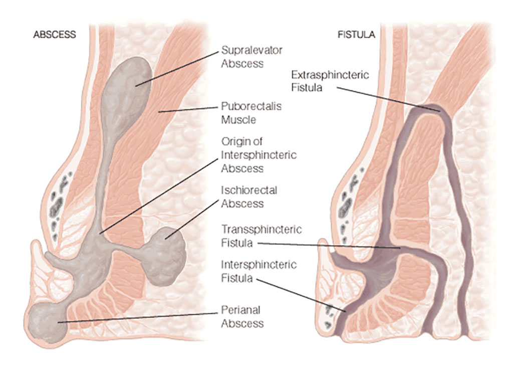 How to Treat Fistula Without Surgery? – Navyam Ayurveda