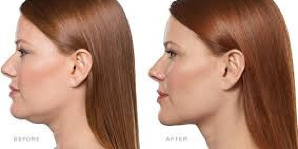 Say Goodbye to Double Chin with Kybella Treatments