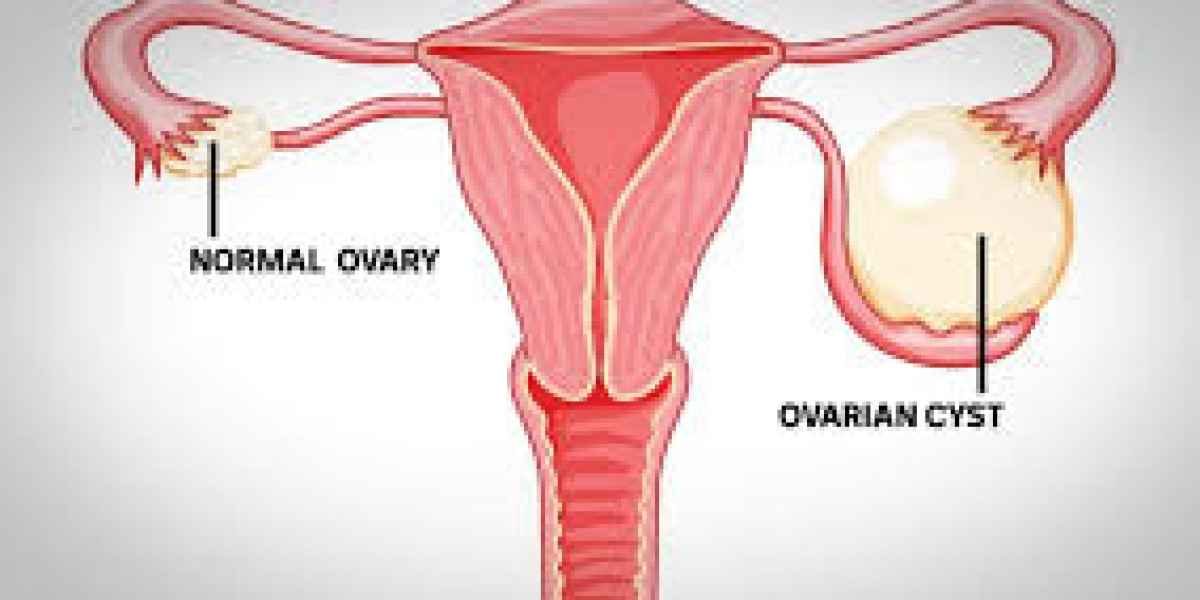 Ovarian Cysts: Are They Dangerous?