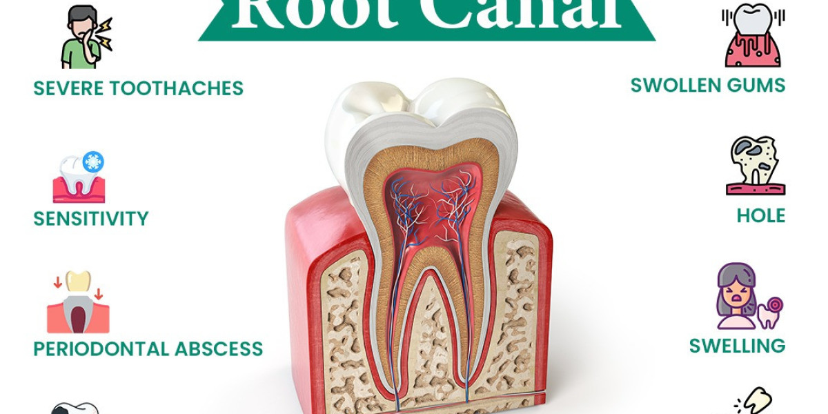 Root Canal Treatment Hospital in Hyderabad, Dental Prophylaxis Hospital, and Clinic for Loose Teeth