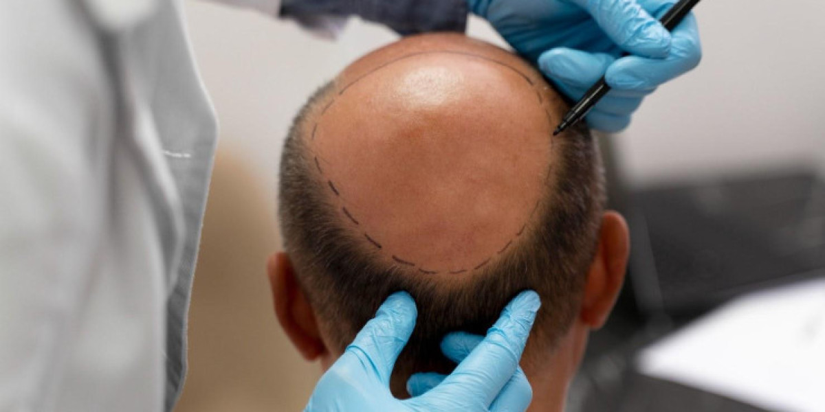 Essential Aftercare Tips for a Smooth Hair Transplant Recovery