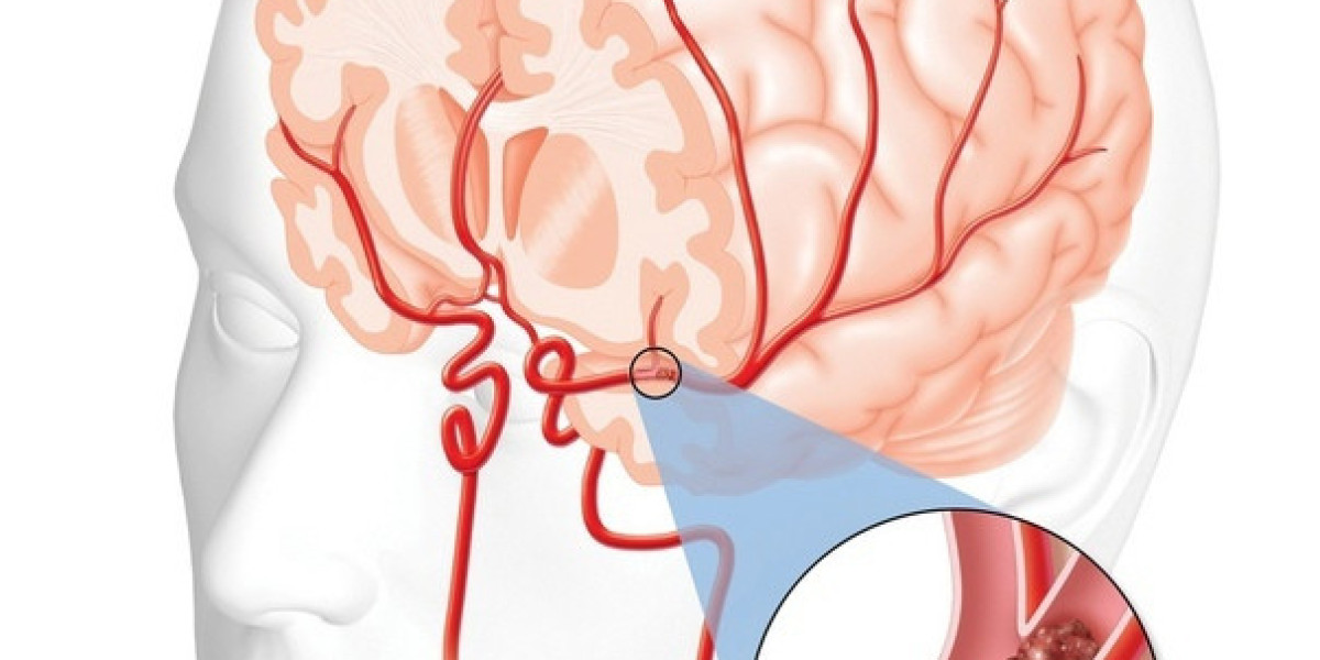 Ischemic Stroke Pipeline Market Poised to Grow at a Steady Pace Due to Rising Prevalence of Stroke