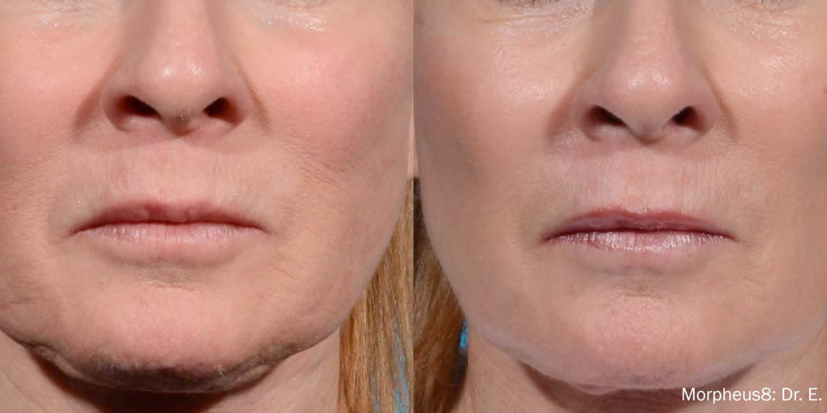 Is Morpheus 8 the Ultimate Solution for Skin Tightening?